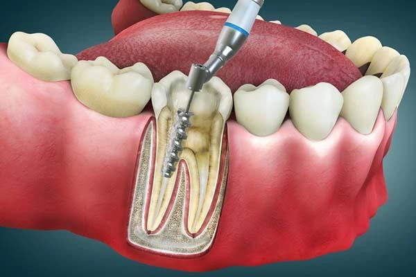 Painless single-visit root canal treatment using advanced rotary technology